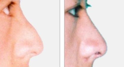 硅胶隆鼻一般价格是多少_做硅胶隆鼻一般要多少钱
