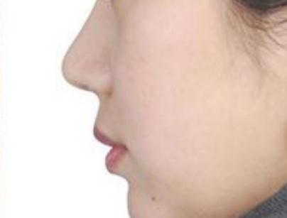 有什么方法可以让鼻子变小_微整鼻子有副作用吗