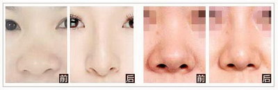 鼻尖整形术的正确方法_鼻尖整形术后的护理有哪些