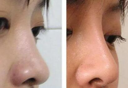 隆鼻后的鼻头恢复正常有多长时间？_隆鼻后的鼻头会在多久时间内才能变软？