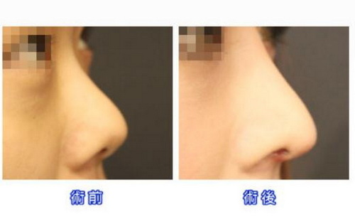 广州哪里治疗鼻甲肥大好_得了严重鼻甲肥大怎么办