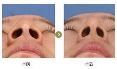 隆鼻要怎么修的_假体隆鼻哪种手术最安全