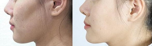 做完隆鼻手术多久可以拔牙_隆鼻手术假体取出来有后遗症吗