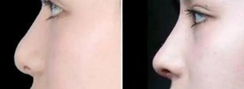 乌龟的鼻子下面为什么有白色点_隆鼻：选取一款最适合你的鼻子