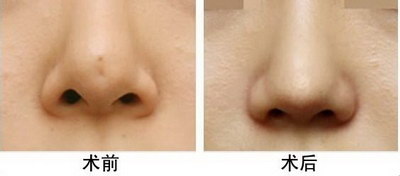 隆鼻导致鼻中隔偏曲不修复会怎么样_隆鼻后鼻中隔偏曲