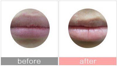 如何改善唇纹