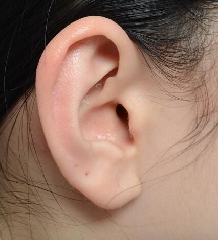 外耳再造手术一期多少钱