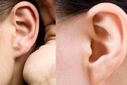 外耳畸形整形需要多少钱