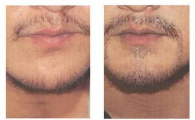 怎么减缓胡子的生长速度_有什么办法让胡子变细