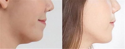 女人脸颊两边长斑是什么原因