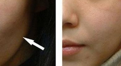 面部填充的脂肪多久可以消失_自体脂肪面部填充多久可以敷面膜