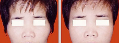 脸部脂肪填充技术可以迅速消肿