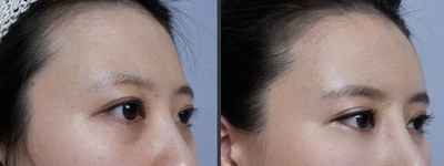 怎么淡化晒斑的产品_脸上晒斑怎么去除或淡化