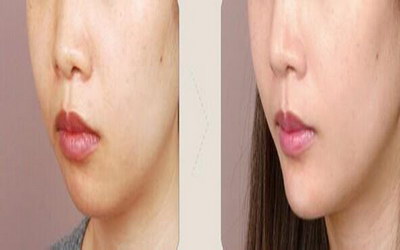 女性脸颊为什么会长斑_左右脸颊痘痘反复长是什么原因