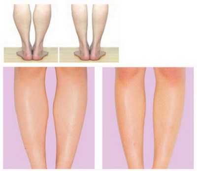 如何瘦大腿和小腿的肌肉_射频溶脂瘦大腿效果明显吗