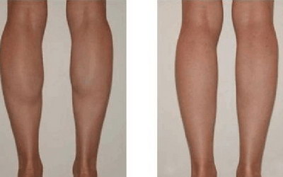 如何减掉大腿和屁股的肉肉_孕期如何减大腿和屁股