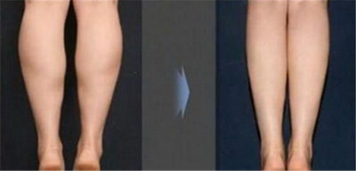 大腿血栓手术风险_大腿小腿粗用什么方法变瘦腿