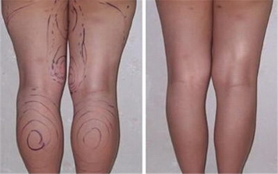 如何锻炼大腿才能变细_大腿根部一条条紫痕像伤疤一样