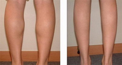 肌肉腿打瘦腿针效果明显吗_打瘦腿针小腿可以瘦多少厘米