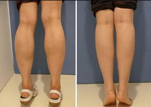 大腿围60吸脂可以到多少厘米_大腿根部粗穿什么裤子显瘦