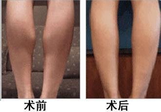 大腿内侧的肥肉多久可以减掉