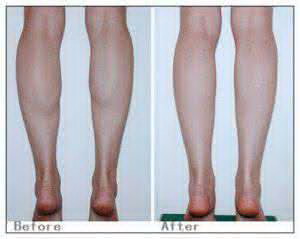整形瘦腿是怎么回事_注射botox瘦腿效果图