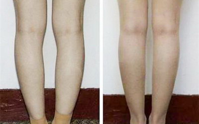 大腿抽脂后多久才能看到最佳效果_大腿抽脂后多久是最瘦的时候