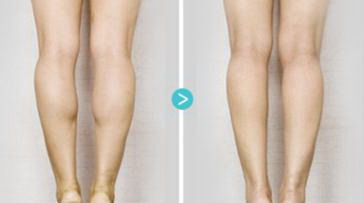 大腿吸脂消肿期是多久(大腿吸脂最快几天消肿)