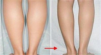 大腿溶脂和抽脂的区别
