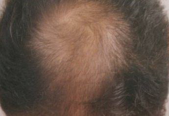 长发是否容易导致脱发问题？