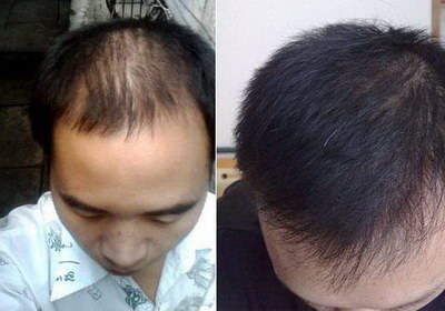 脱发最有效的治疗方法(脱发严重？教你最有效的治疗方法)