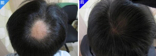 内分泌失调引起的脱发如何治疗_毛囊炎脱发还能长出来吗