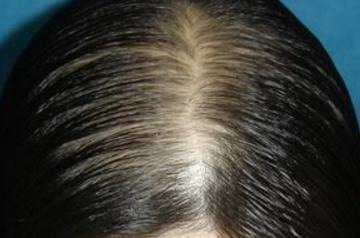 造成脂溢性脱发的主要原因