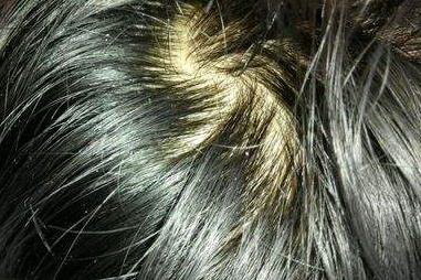 女性雄激素脱发怎么治疗_造成脂溢性脱发的主要原因