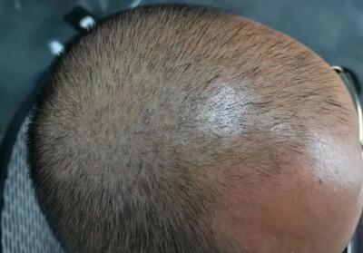 脂溢性脱发怎么调理(什么是脂溢性脱发？)