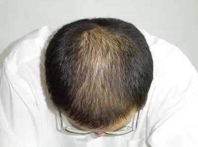 脱发很严重有什么办法(为什么会出现严重的脱发？)