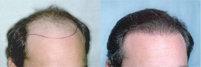 女性雌性激素低导致脱发