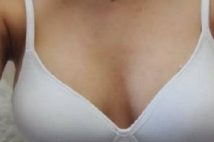 为什么乳房有时候特别热_纹乳房多长时间恢复