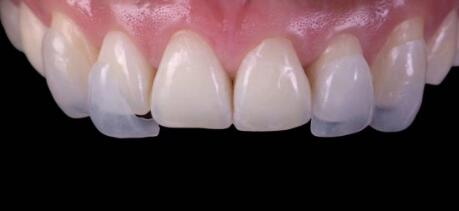 品瑞洁牙优点_超声波洁牙机的优势大于其他洁牙方式