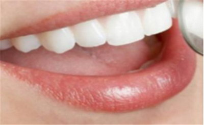 牙齿变白的方法男生_如何治疗牙齿突出：让你的微笑完美无瑕