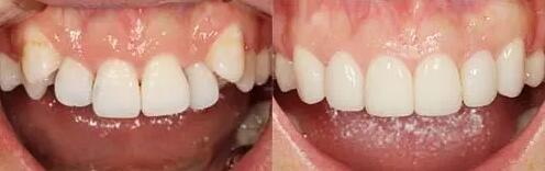 牙槽骨萎缩种植牙