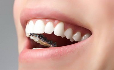 牙齿填充修复最好的材料
