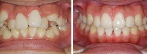 成人正畸牙齿的危害