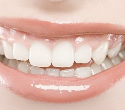 牙套矫正牙齿年龄限制