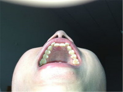 牙龈长到牙齿缝