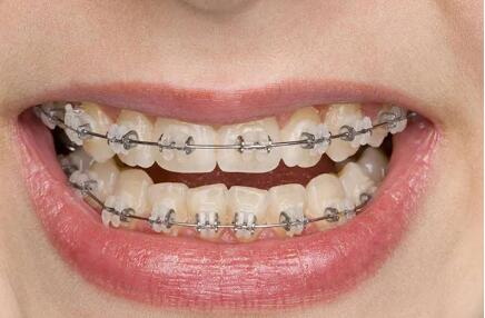 如何才能让牙齿更白_宁波隐形牙齿矫正