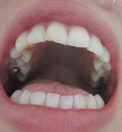 牙齿矫正后的黑三角怎么处理