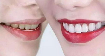 牙齿整形美白一般保持多久