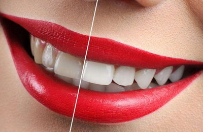 成人可以做牙齿整形吗？