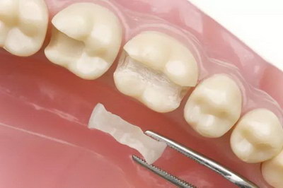 牙龈萎缩能种植牙不_牙龈萎缩能种植牙吗